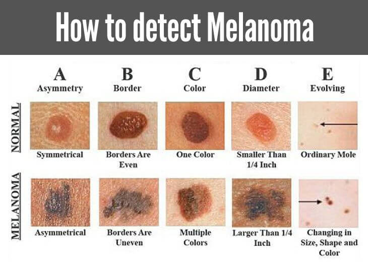 How to check if a mole is cancerous, cancer in moles, skin cancer signs